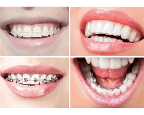 todo sobre brackets metalicos|que es un bracket.